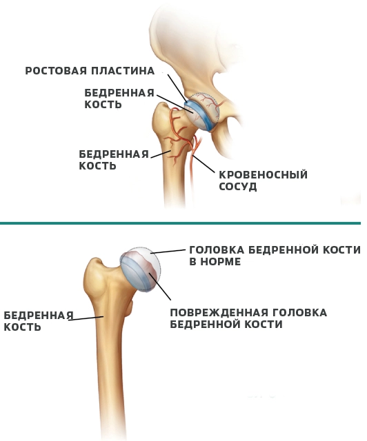 Причины болезни Пертеса
