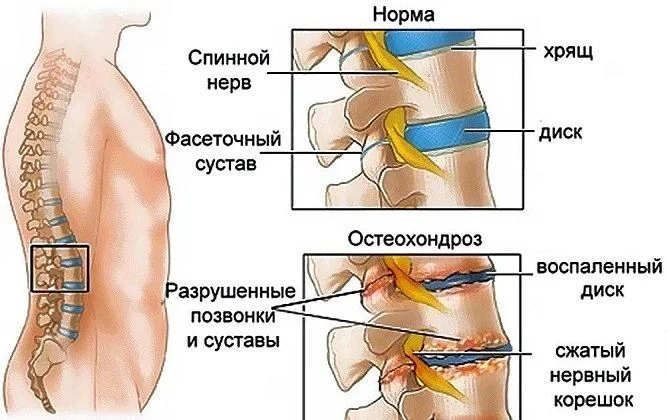 Разрушение позвонков при остеохондрозе