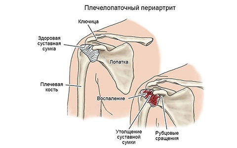 Плечелопаточный периартрит Плечелопаточный периартрит